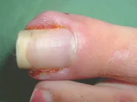 ワイヤー矯正治療（VHO）