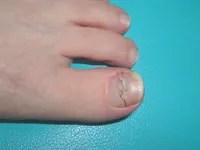 人工爪でカバー